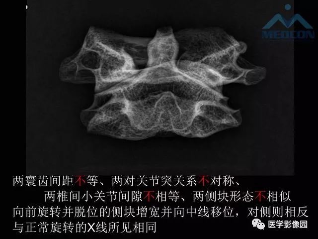 【PPT】寰枢关节脱位的影像诊断