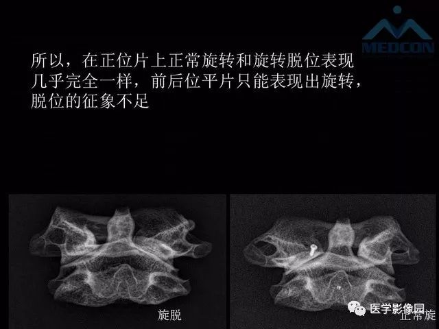 【PPT】寰枢关节脱位的影像诊断