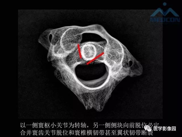 【PPT】寰枢关节脱位的影像诊断