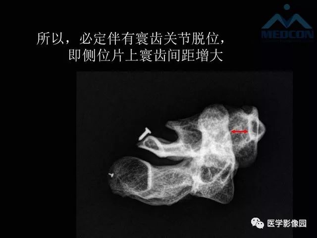 【PPT】寰枢关节脱位的影像诊断