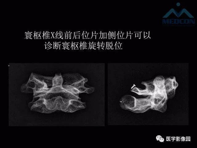 【PPT】寰枢关节脱位的影像诊断