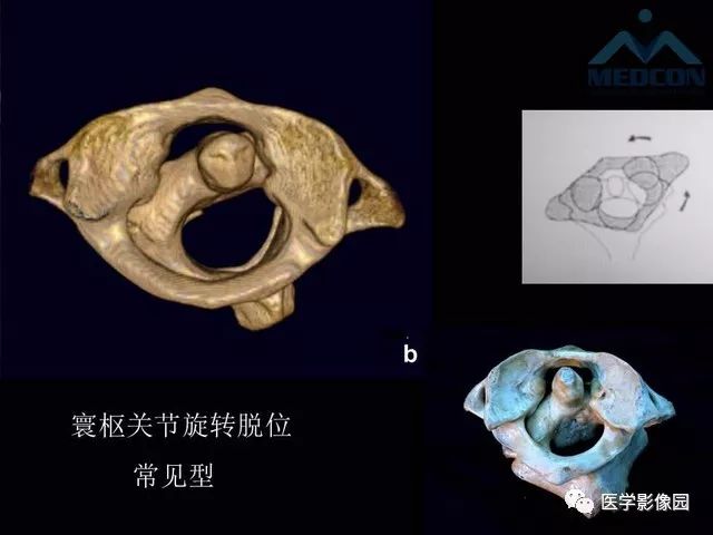 【PPT】寰枢关节脱位的影像诊断