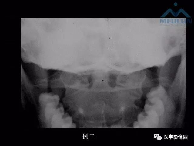 【PPT】寰枢关节脱位的影像诊断