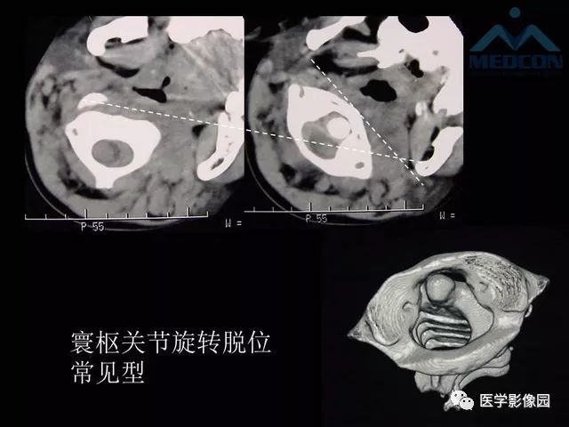 【PPT】寰枢关节脱位的影像诊断