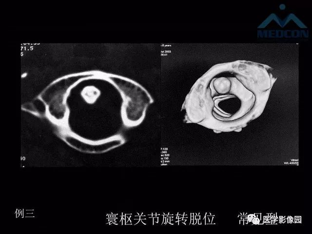 【PPT】寰枢关节脱位的影像诊断