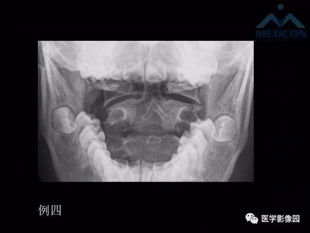【PPT】寰枢关节脱位的影像诊断