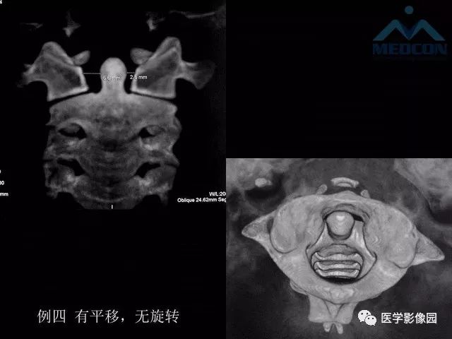 【PPT】寰枢关节脱位的影像诊断