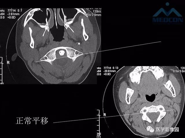 【PPT】寰枢关节脱位的影像诊断
