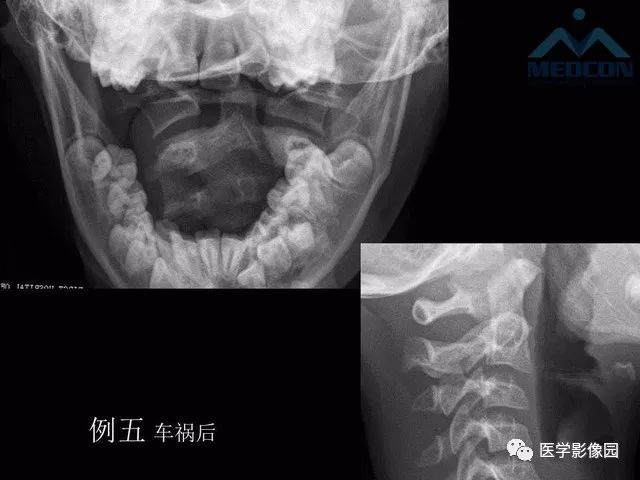 【PPT】寰枢关节脱位的影像诊断