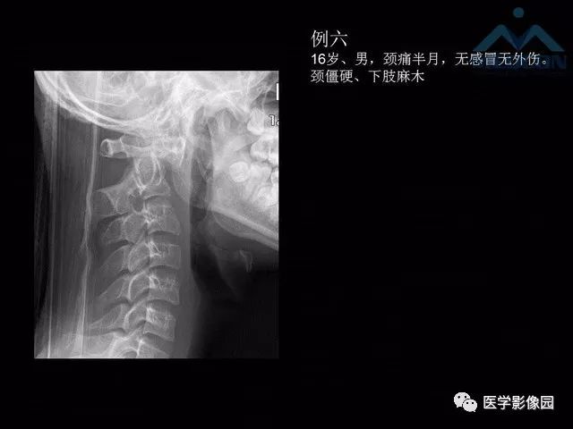 【PPT】寰枢关节脱位的影像诊断