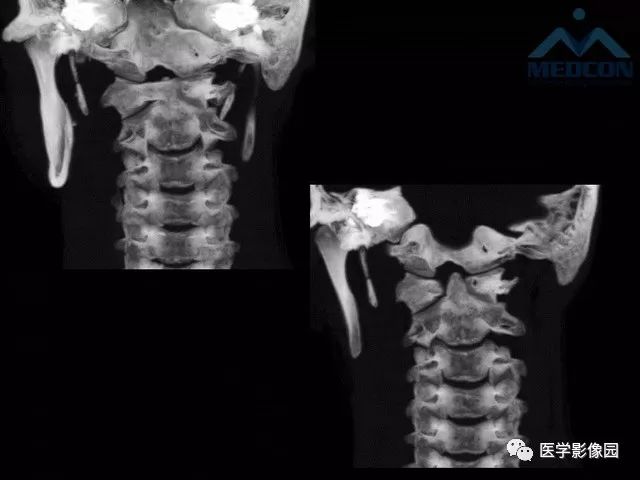 【PPT】寰枢关节脱位的影像诊断