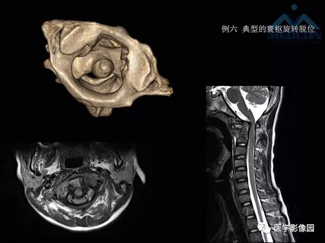 【PPT】寰枢关节脱位的影像诊断