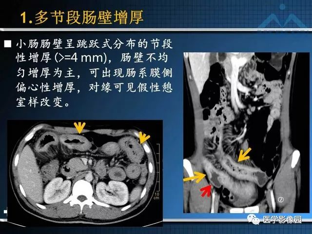 【PPT】克罗恩病的MSCT诊断
