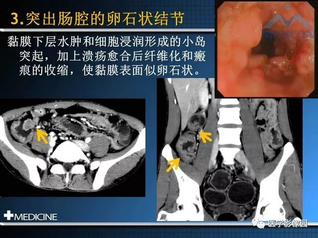 【PPT】克罗恩病的MSCT诊断
