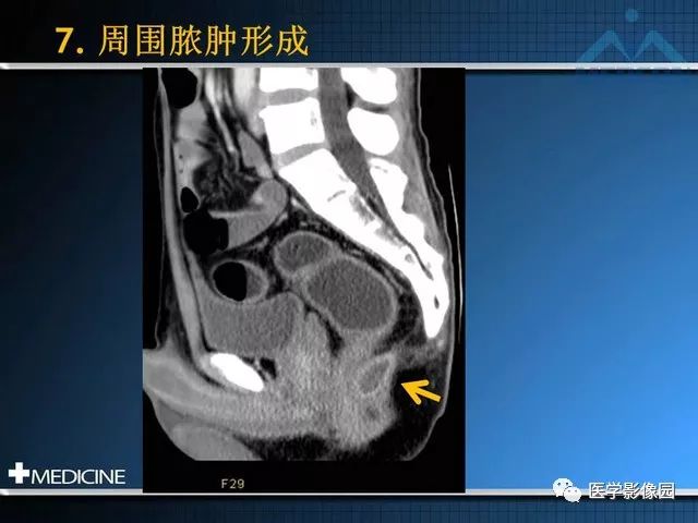 【PPT】克罗恩病的MSCT诊断