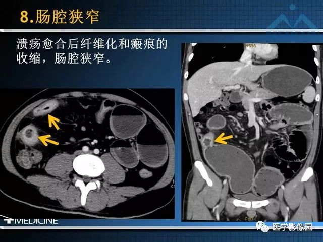 【PPT】克罗恩病的MSCT诊断