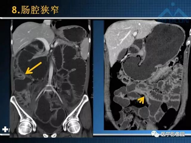 【PPT】克罗恩病的MSCT诊断