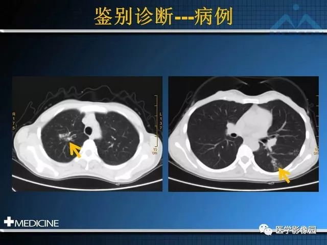【PPT】克罗恩病的MSCT诊断