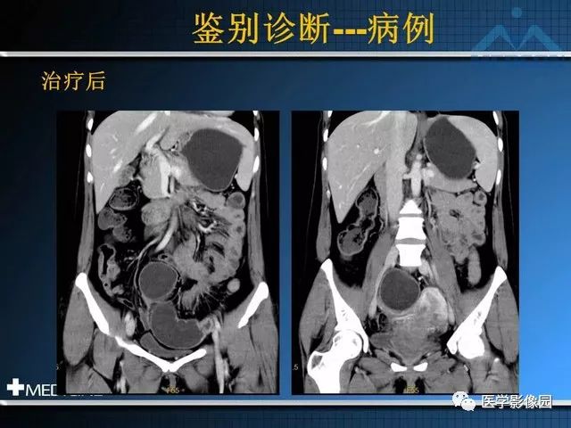 【PPT】克罗恩病的MSCT诊断