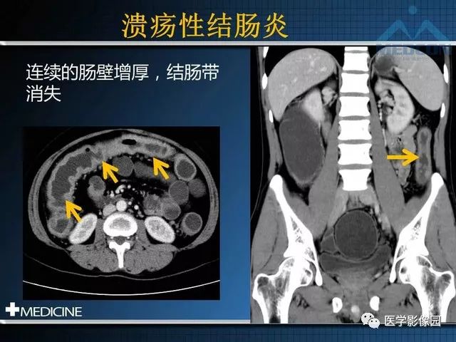 【PPT】克罗恩病的MSCT诊断