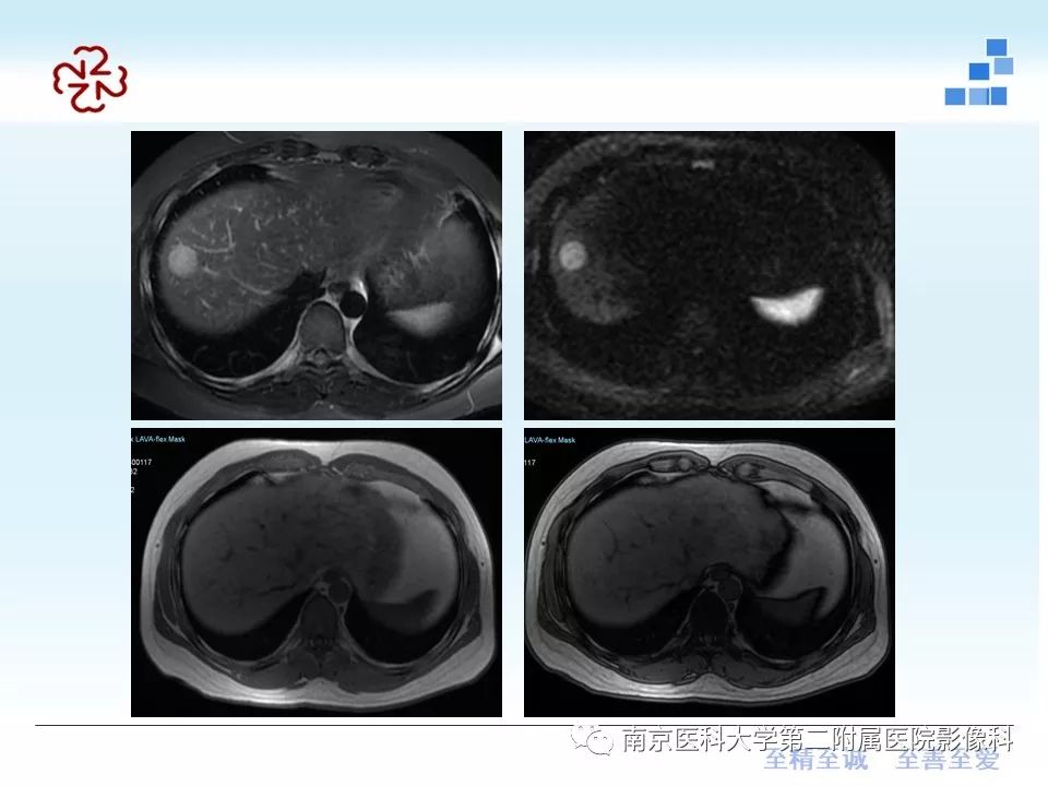 【PPT】肝腺瘤的影像学表现