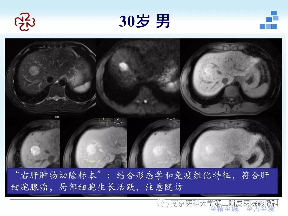 【PPT】肝腺瘤的影像学表现