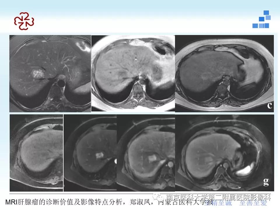 【PPT】肝腺瘤的影像学表现