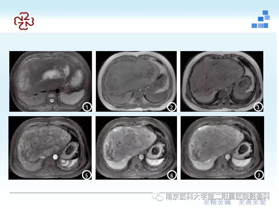 【PPT】肝腺瘤的影像学表现