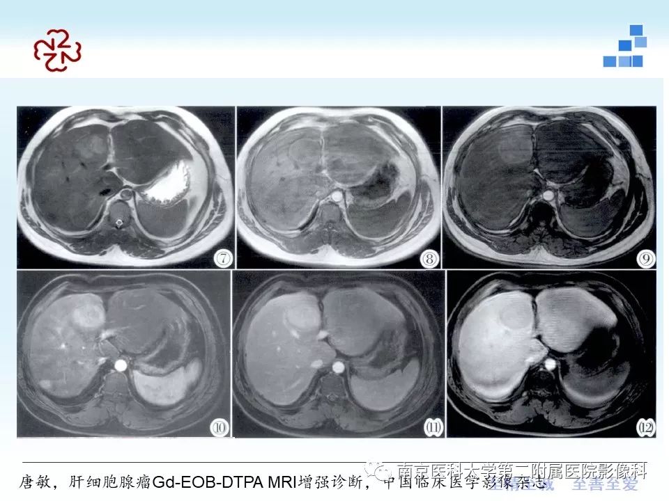 【PPT】肝腺瘤的影像学表现