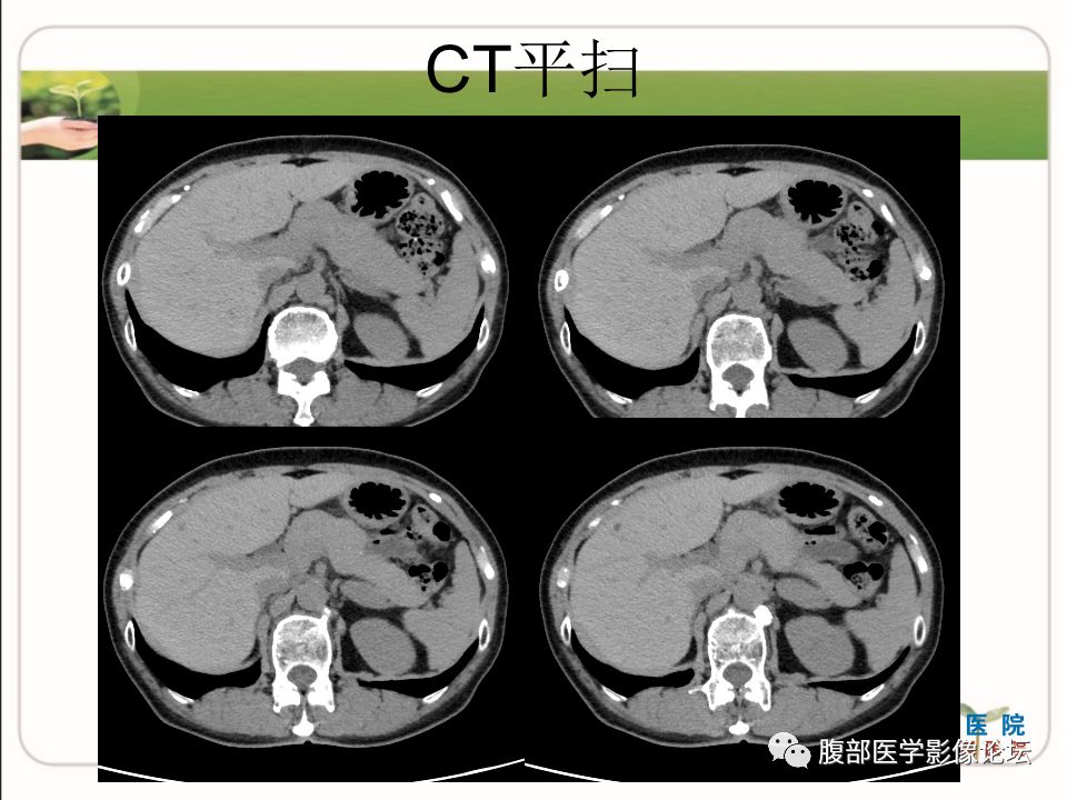 【病例】肾上腺节细胞神经瘤1例CT