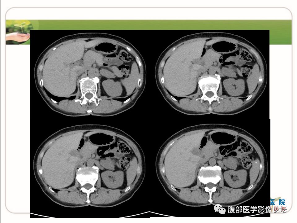 【病例】肾上腺节细胞神经瘤1例CT