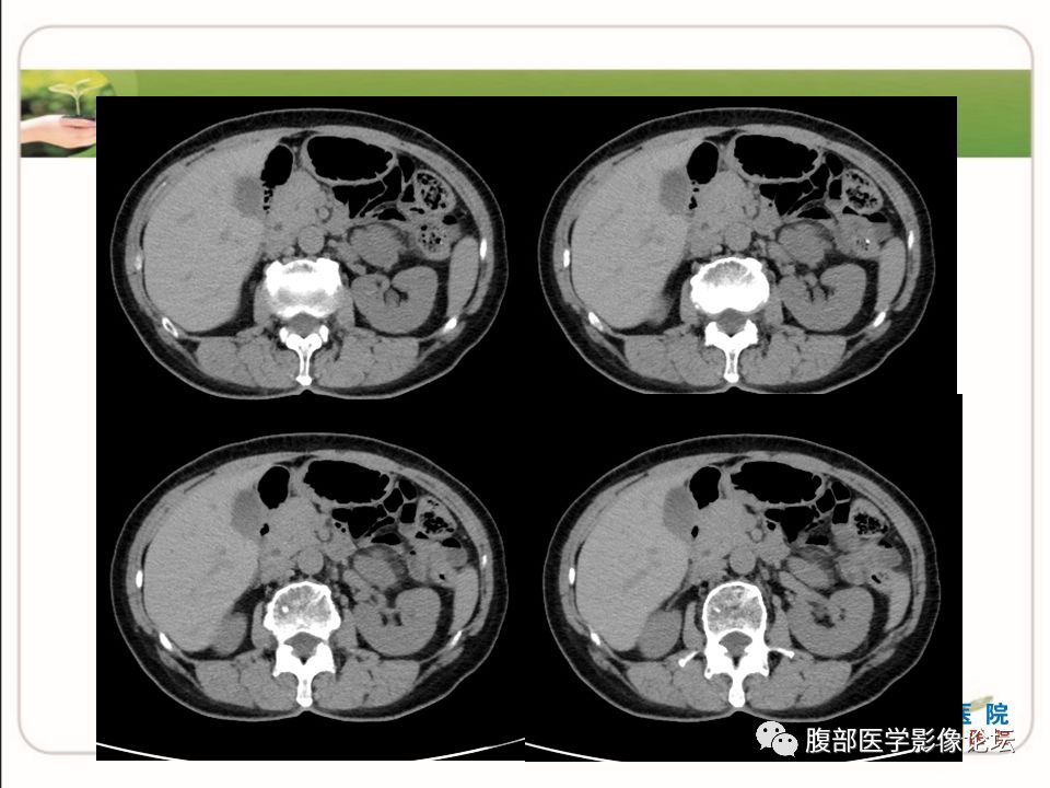 【病例】肾上腺节细胞神经瘤1例CT