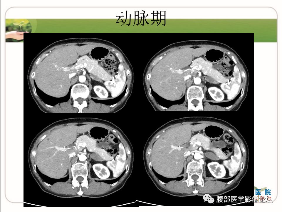 【病例】肾上腺节细胞神经瘤1例CT