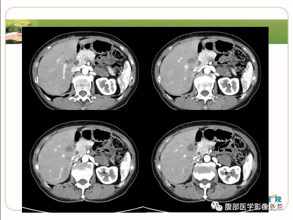 【病例】肾上腺节细胞神经瘤1例CT