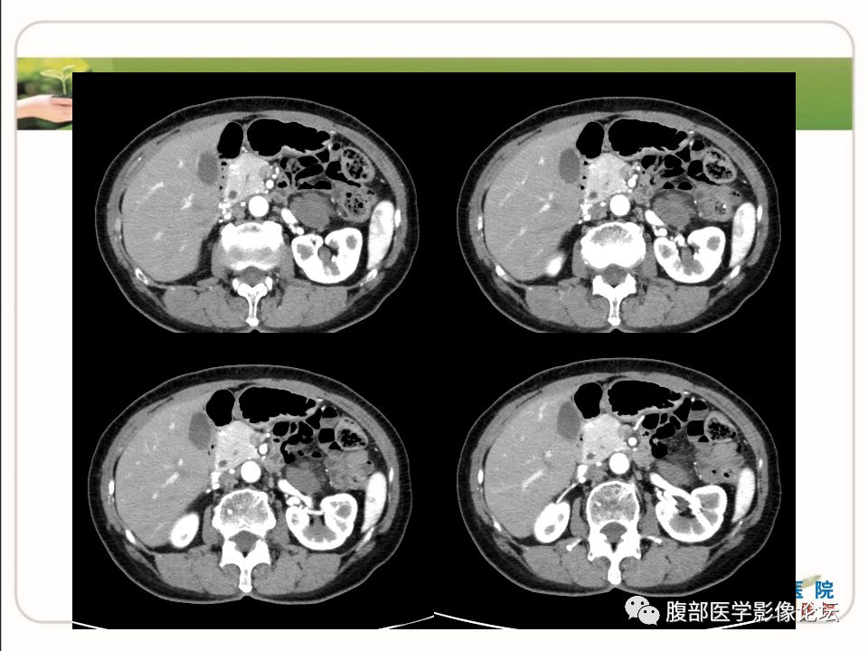 【病例】肾上腺节细胞神经瘤1例CT