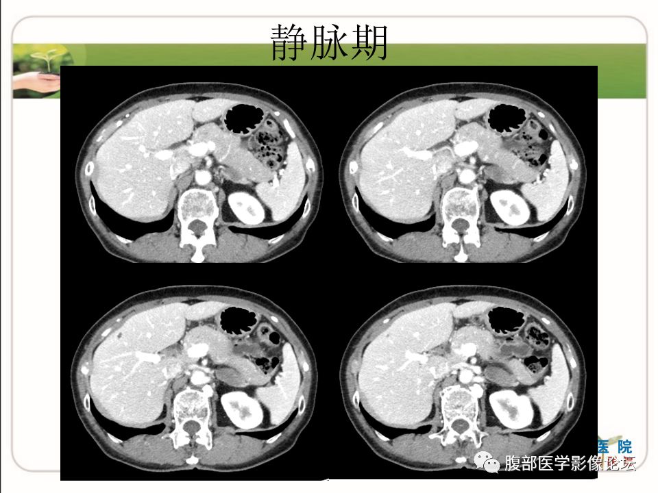 【病例】肾上腺节细胞神经瘤1例CT