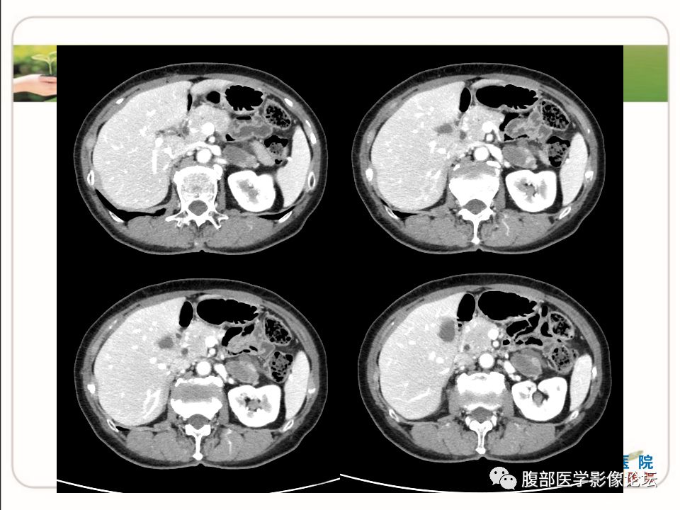 【病例】肾上腺节细胞神经瘤1例CT