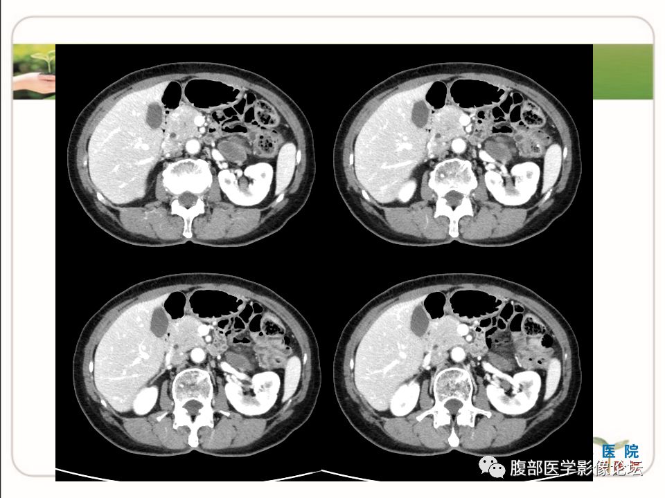 【病例】肾上腺节细胞神经瘤1例CT