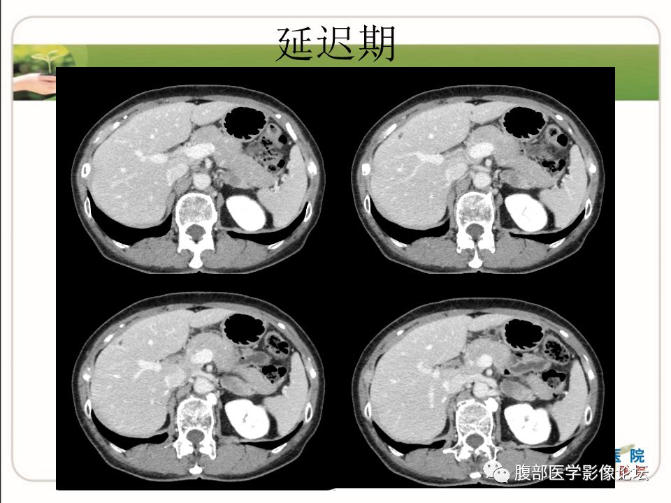 【病例】肾上腺节细胞神经瘤1例CT