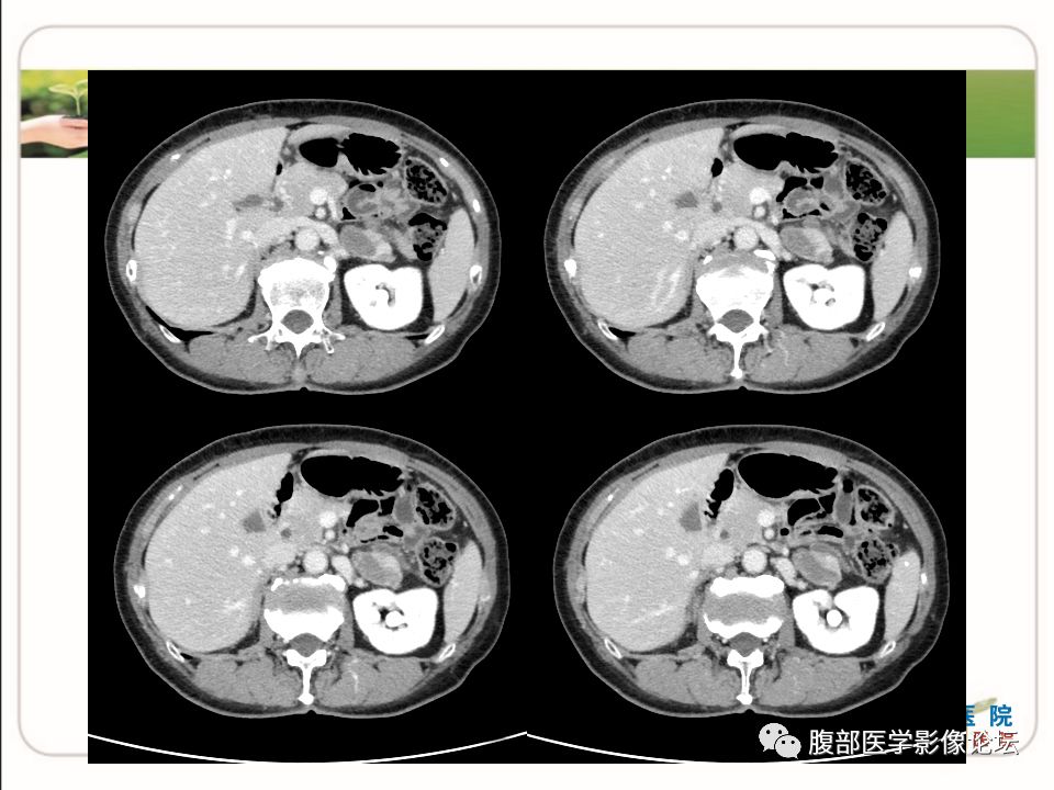 【病例】肾上腺节细胞神经瘤1例CT