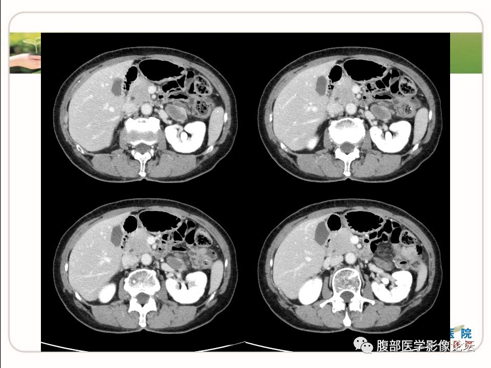 【病例】肾上腺节细胞神经瘤1例CT