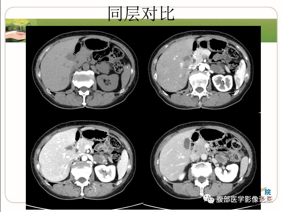 【病例】肾上腺节细胞神经瘤1例CT