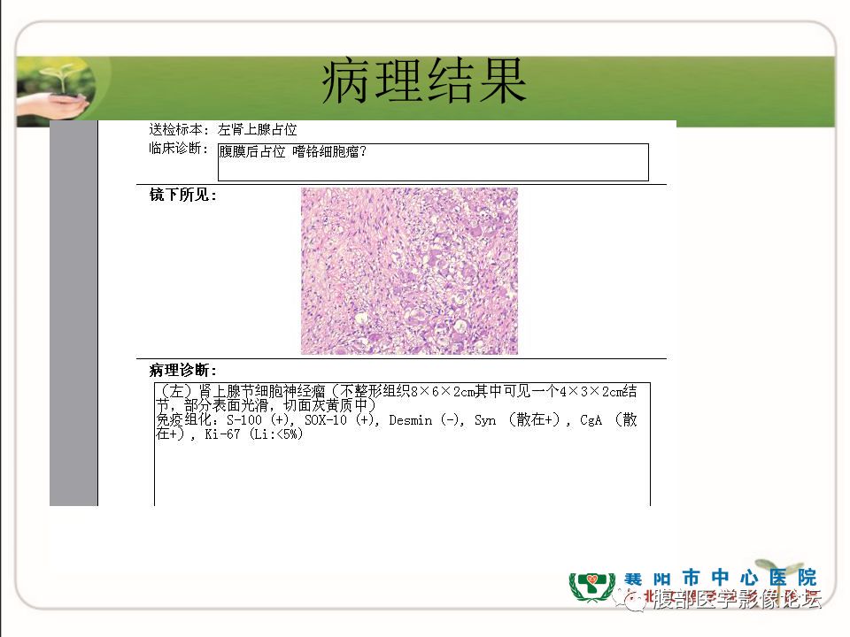 【病例】肾上腺节细胞神经瘤1例CT