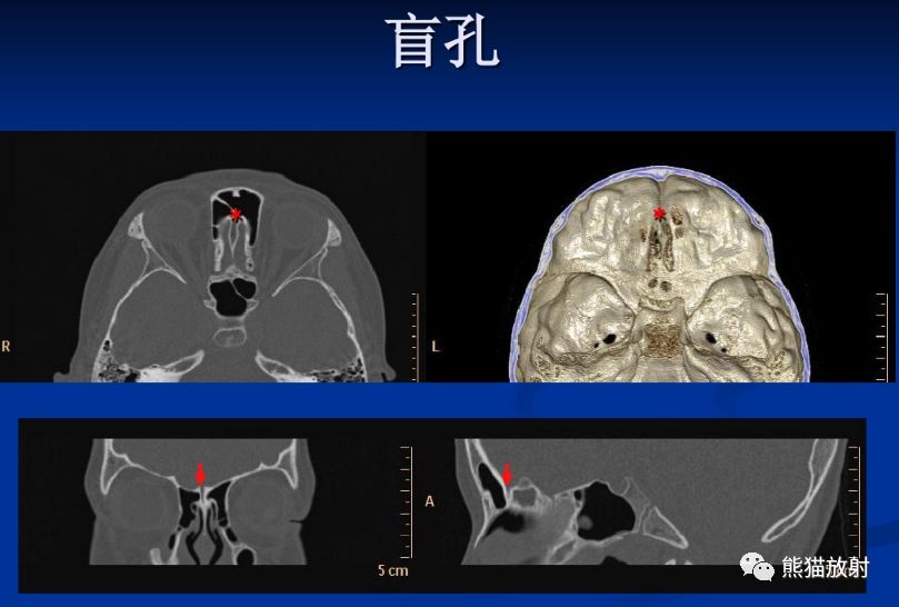 颅底孔道及内容物