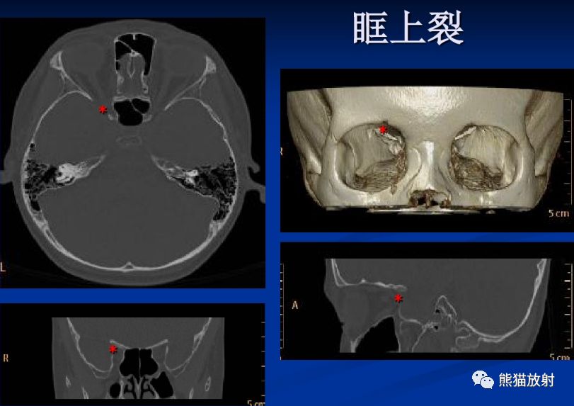 颅底孔道及内容物