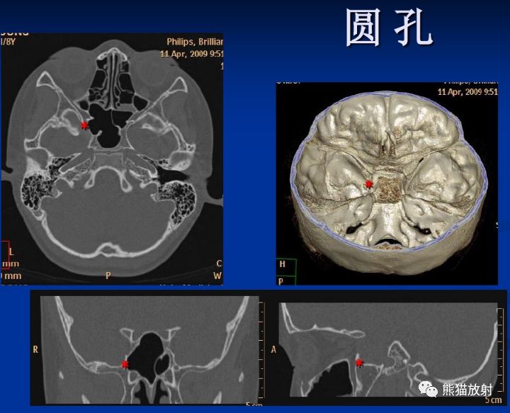 颅底孔道及内容物
