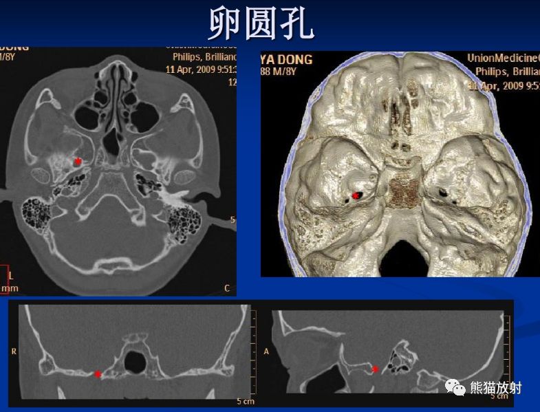 颅底孔道及内容物