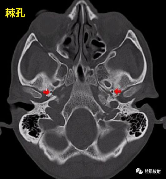 颅底孔道及内容物