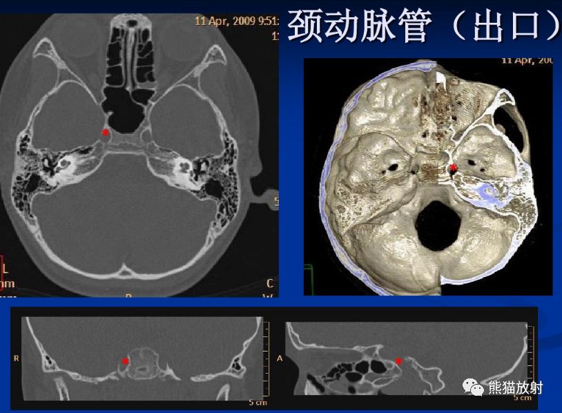 颅底孔道及内容物