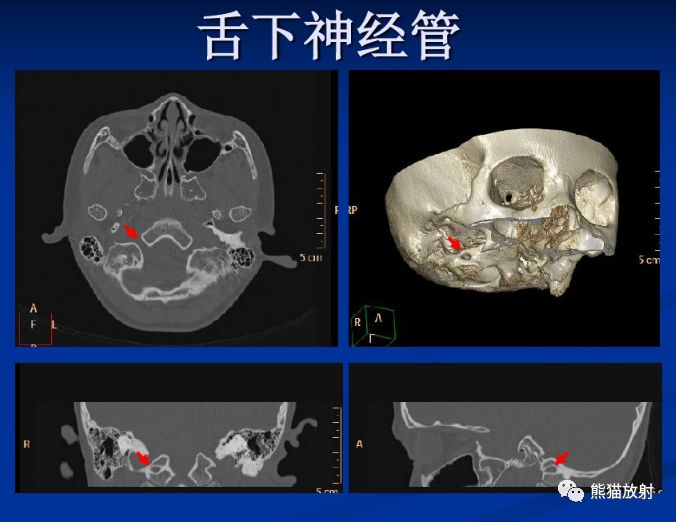 颅底孔道及内容物